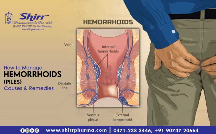  How to Manage Hemorrhoids ( Piles ) – Causes & Remedies