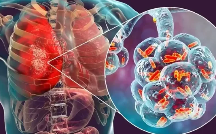 Pneumonia: The Hidden Danger to Your Lungs – Symptoms, Prevention & Care