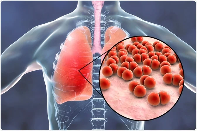 Pneumonia: The Hidden Danger to Your Lungs – Symptoms, Prevention & Care